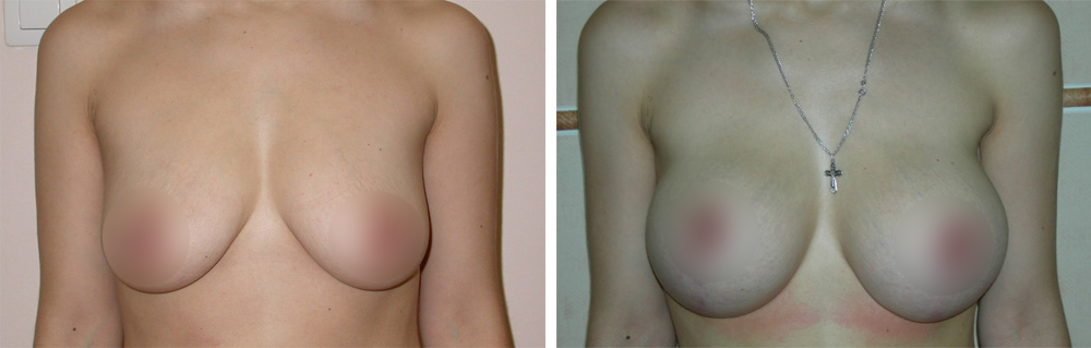 Подтяжка груди с эндопротезированием