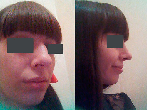 Ринопластика горбинки носа - фото до и после. Оперировал Усачёв И.А.