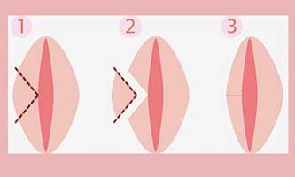 Клиновидная резекция малых половых губ - До и После