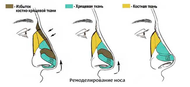 Этапы пластики длинного носа