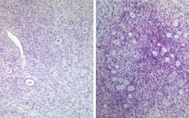 Слева – здоровые ткани яичника, справа – после лечения ABVD: количество фолликулов и яйцеклеток увеличилось.