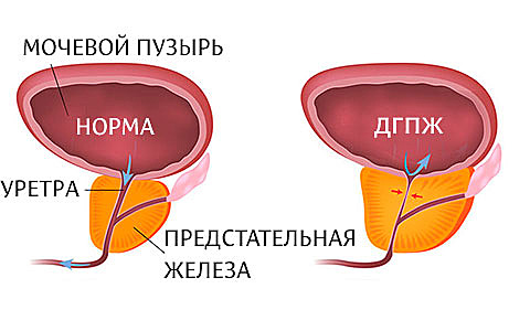 ДГПЖ - доброкачественная гиперплазия предстательной железы