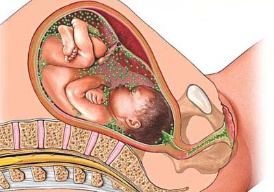 Бактериальный вагиноз у беременной