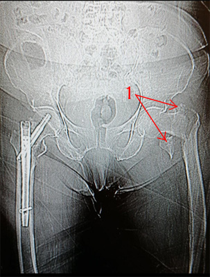 1.	На снимке - оскольчатый перелом проксимального отдела левой  бедренной кости (базальной шейки, большого и малого вертела).