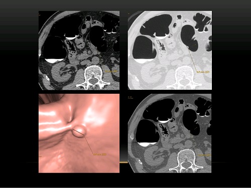 Полип кишечника на широком основании, выявленный на виртуальной (КТ) колоноскопии