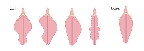 Пластика малых половых губ - До и После