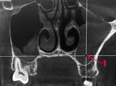 Компьютерная томография показала картину двустороннего одонтогенного гайморита, инородное тело правой верхнечелюстной пазухи, искривление перегородки носа , гипертрофию слизистой нижних носовых раковин