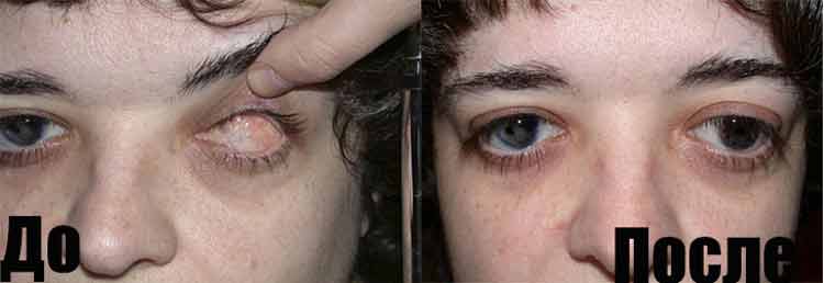 Фото ДО и После  этапного протезирования глаза, выполненного проф.Давыдовым Д.В.